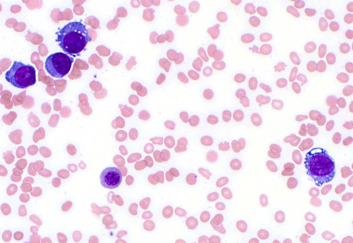 Bone marrow aspirate consisting predominantly of left-shifted, dysplastic erythroids (Wright-Giemsa, 500x)